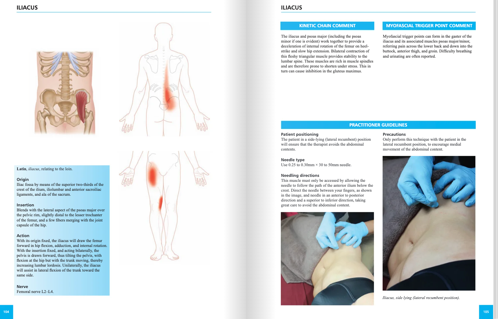The Concise Book of Dry Needling