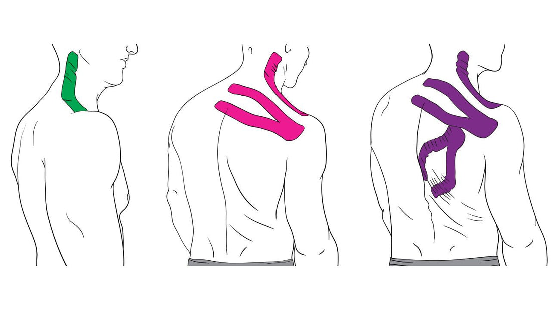 Taping for Common Shoulder Injuries - Niel Asher Education