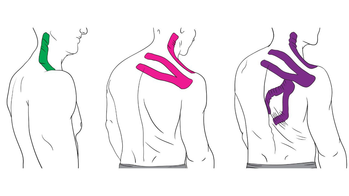 Taping for Common Shoulder Injuries - Niel Asher Education