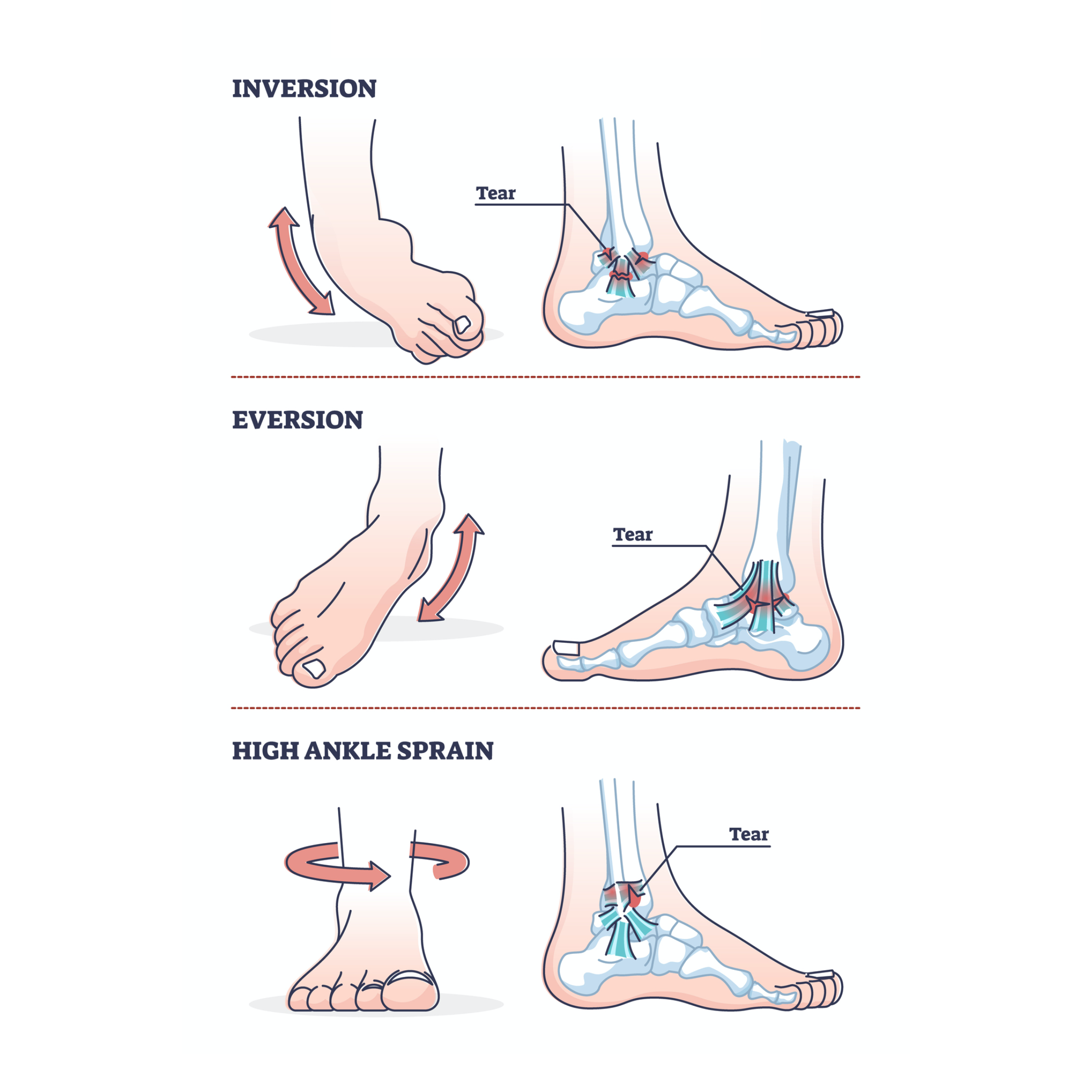 Medial Ankle Sprain