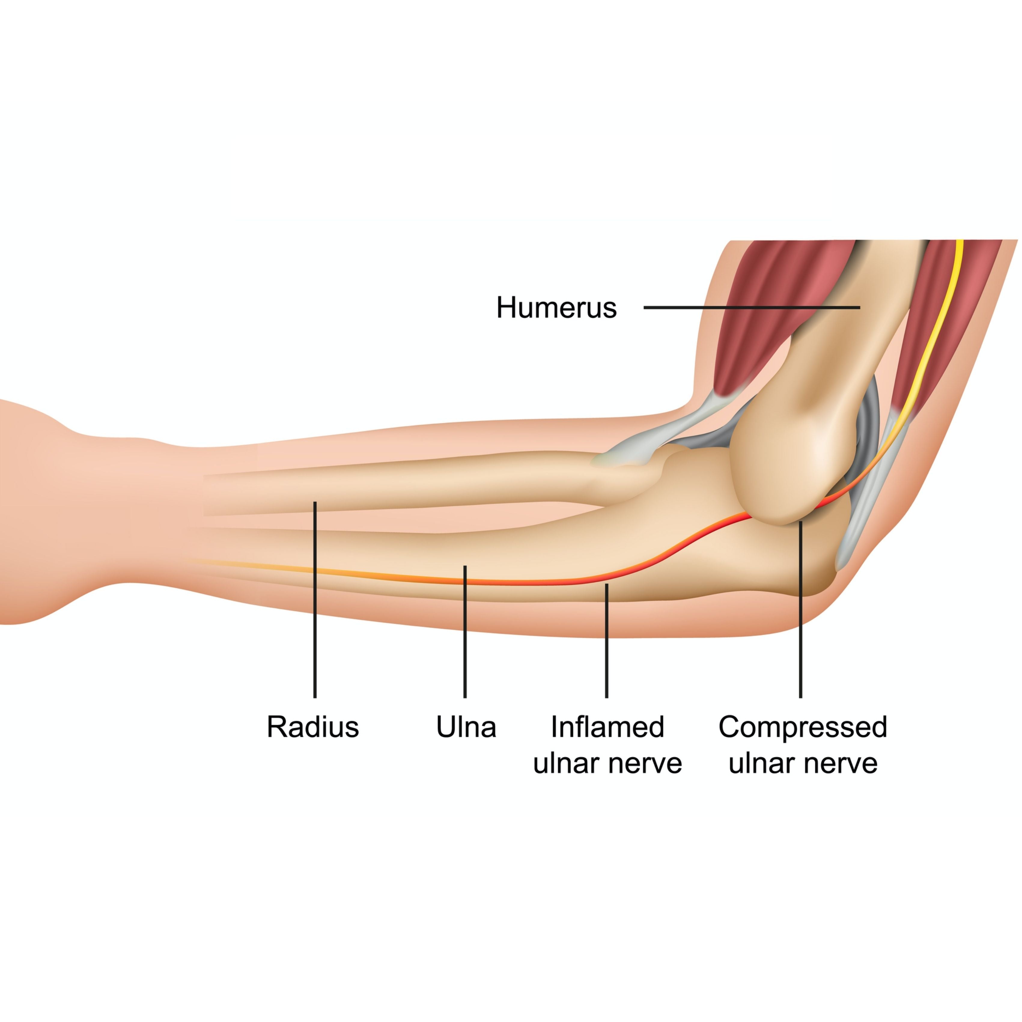 Treating Cubital Tunnel Syndrome  Cubital Tunnel Syndrome, Elbow
