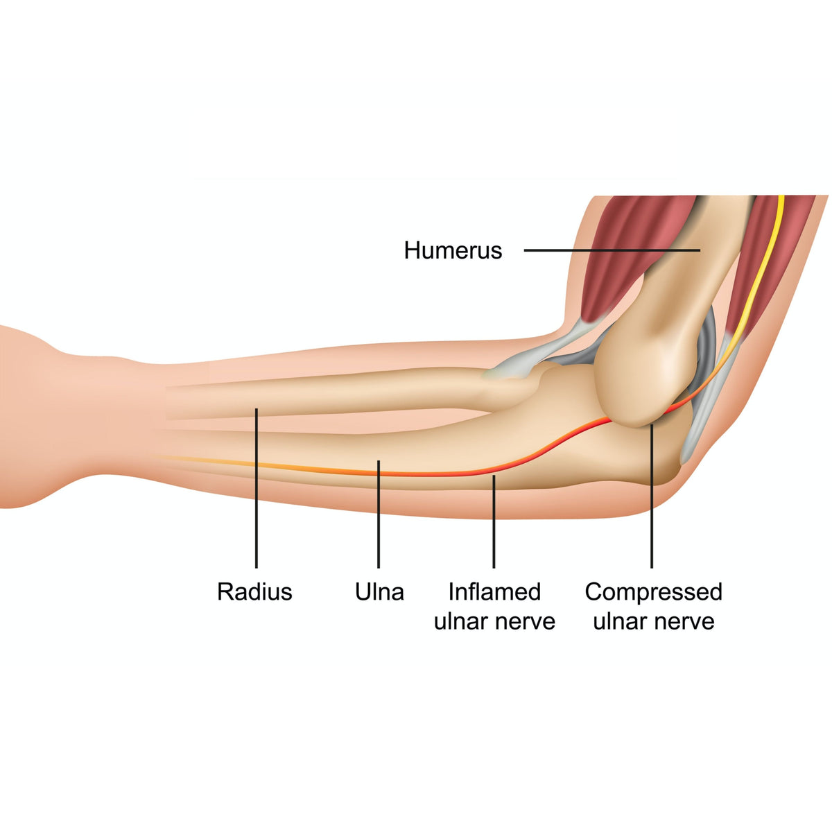 Treating Cubital Tunnel Syndrome - Niel Asher Education