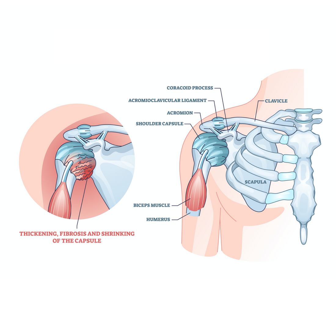 Trigger Point Therapy - Defining a Frozen Shoulder - Niel Asher Education