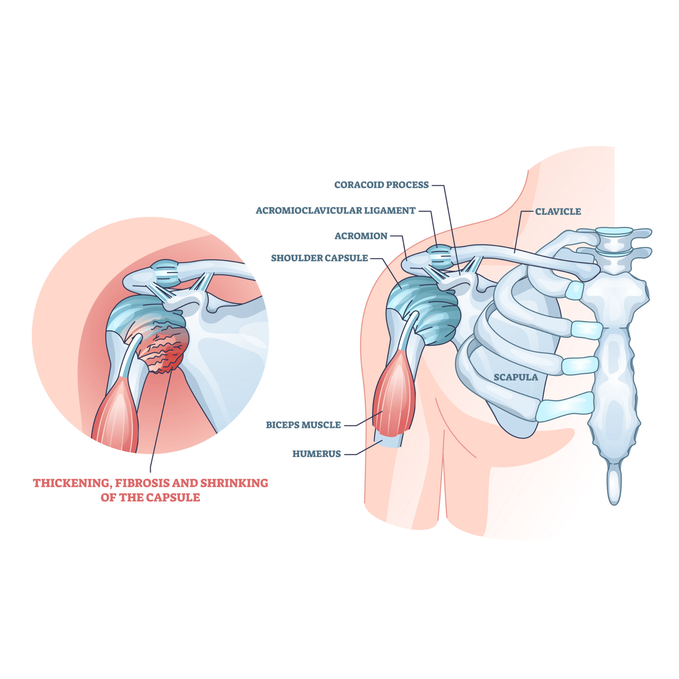 Frozen Shoulder - What is Happening to the Shoulder?, Frozen Shoulder,  Shoulder and more