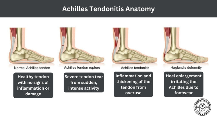 How to Treat Achilles Tendinitis | Achilles Tendinitis and more | Niel ...