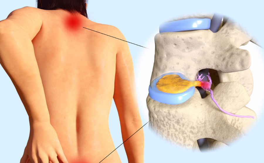 Herniated Disc 