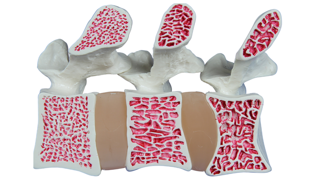 Osteoporosis and Prevention: Understanding the Silent Disease and How to Protect Your Bones - Niel Asher Education