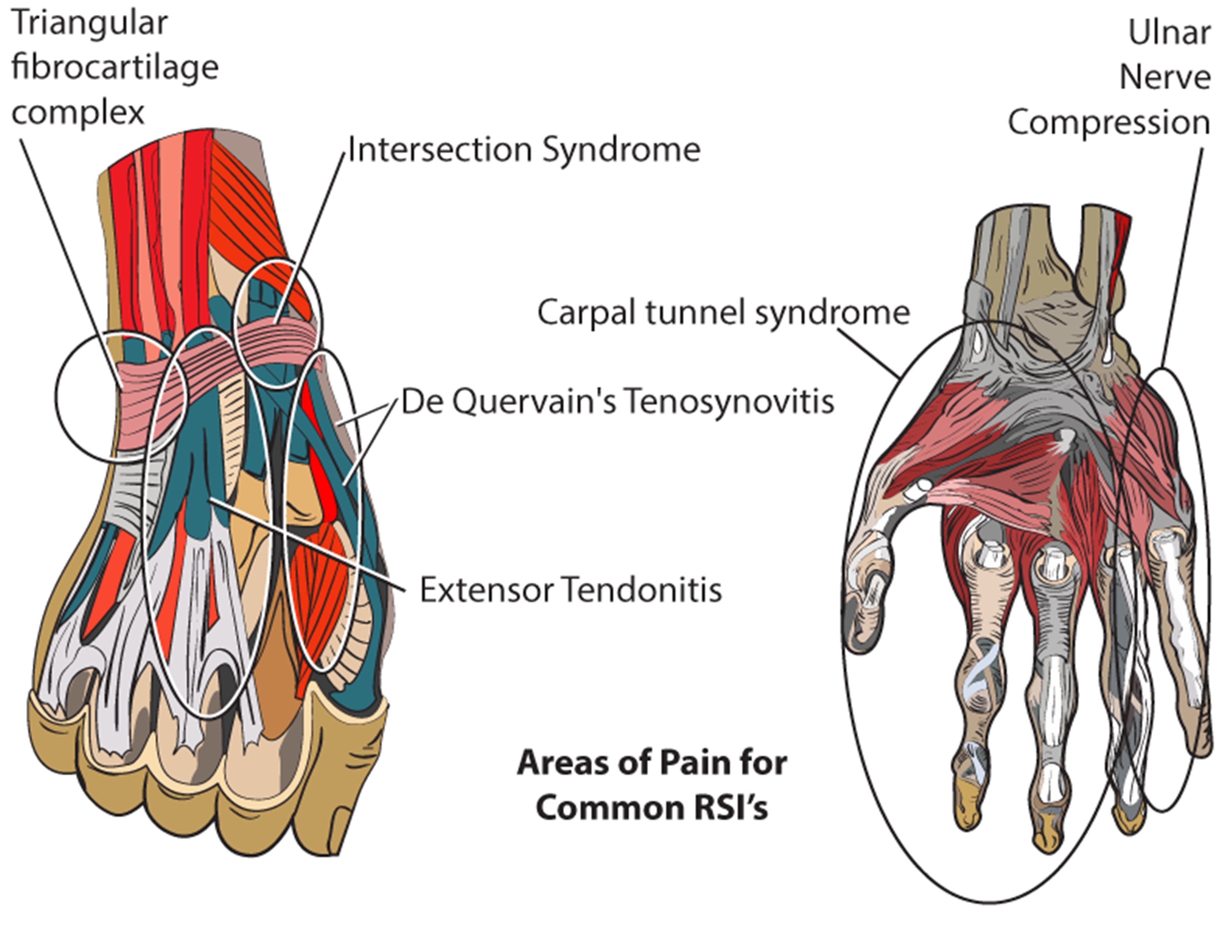Tackling RSI Hand Injuries: Symptoms, Treatments, and Self-Help Tips |  Carpal Tunnel Syndrome, Cubital Tunnel Syndrome, Drop Wrist and more | Niel  Asher Education Blogs and Articles blog