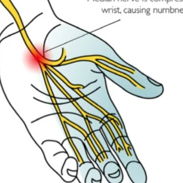 Carpal Tunnel Syndrome | Soft Tissue Therapy | Trigger Point Release ...