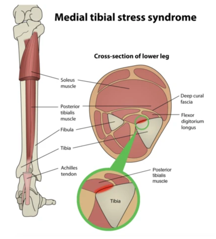 How to Treat Medial Tibial Stress Syndrome (Shin Splints) - Niel Asher Education