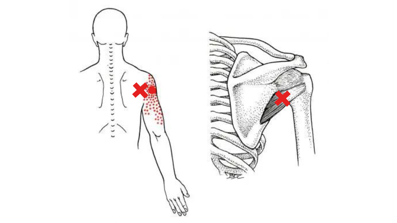 Teres Minor Trigger Points