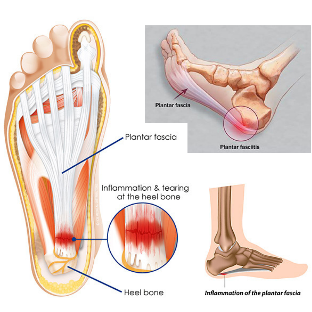 Orthocare Wellness Clinic - #Understanding_Plantar_Fasciitis Plantar  fasciitis is most commonly caused by repetitive strain injury to the  ligament of the sole of the foot. Such strain injury can be from excessive  running