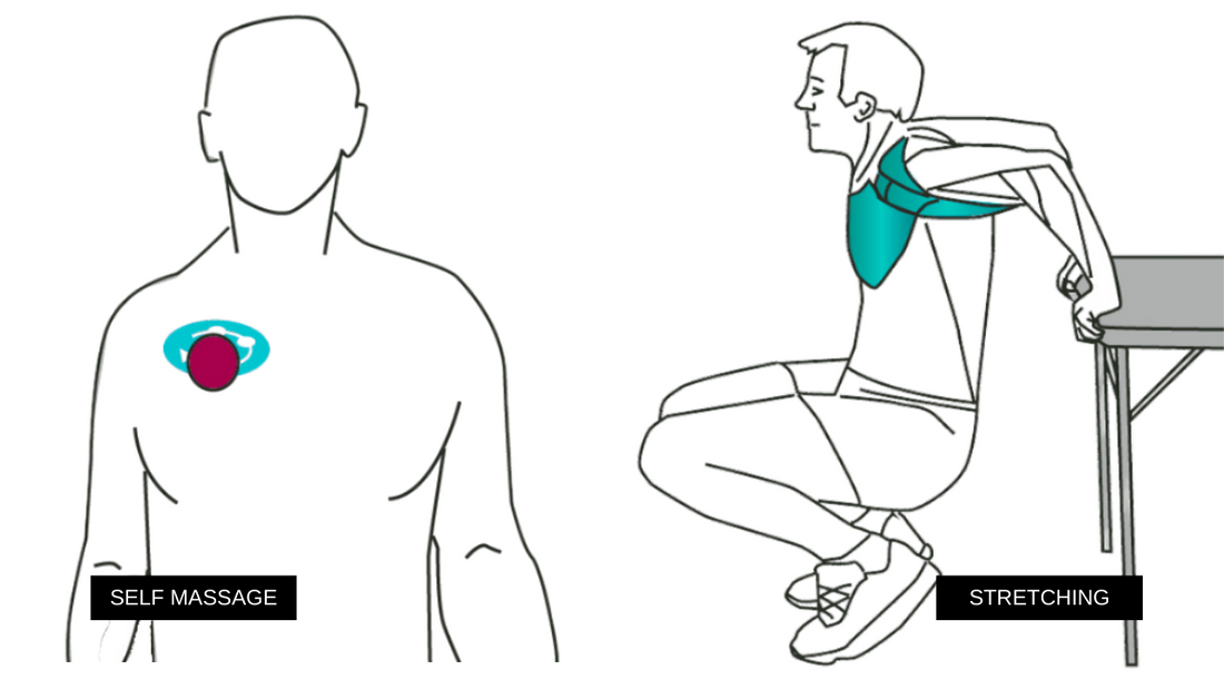 Chest Pain - Trigger Points in Pectoralis Muscles