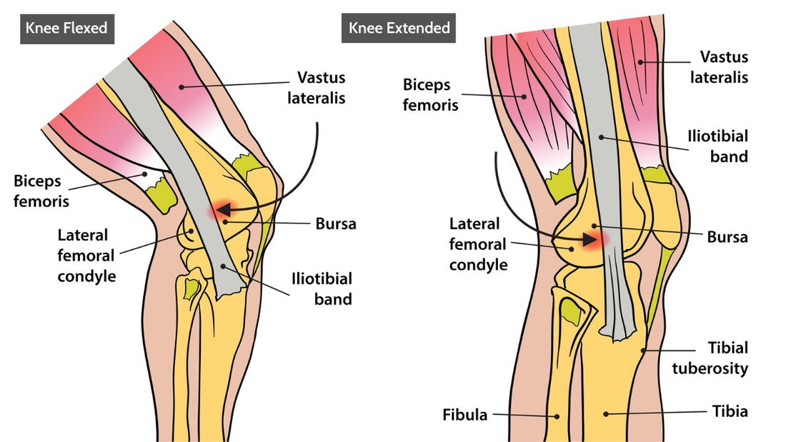 It Band Syndrome and Trigger Points