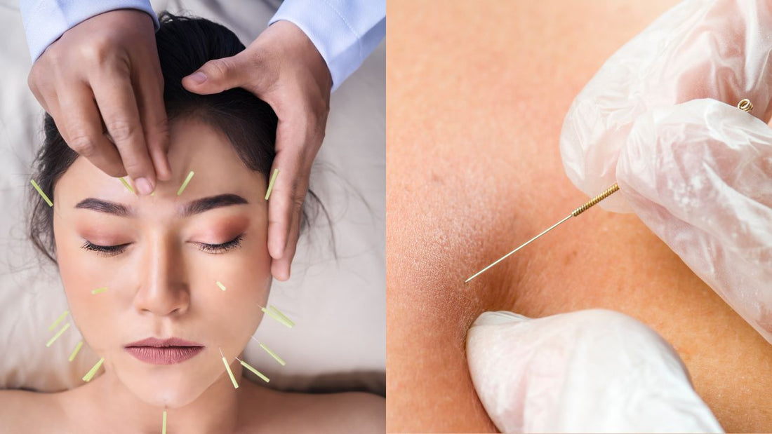 Dry Needling vs. Traditional Acupuncture