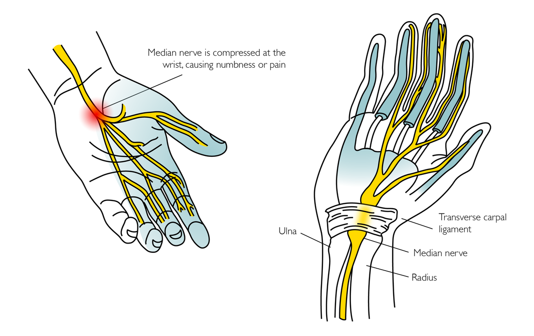 Flick, Tap, and Stretch: Diagnosing and Managing Carpal Tunnel Syndrome - Niel Asher Education