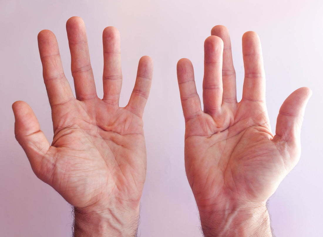 Treatment for Dupuytren’s Contracture - Niel Asher Education