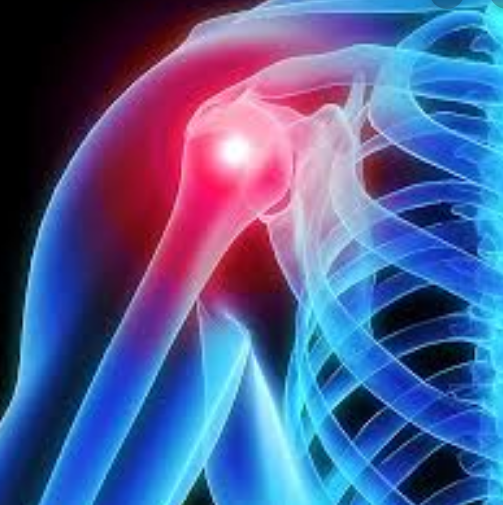 Shoulder Arthritis - Self Help Options - Niel Asher Education