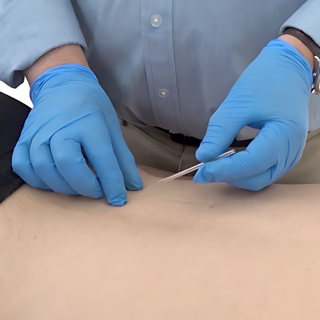 Trigger Point Dry Needling (IMS)