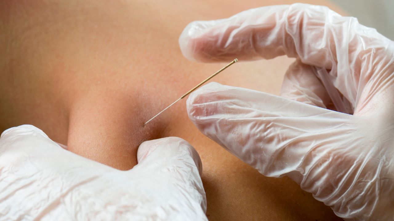 Dry Needling for Trigger Point Release